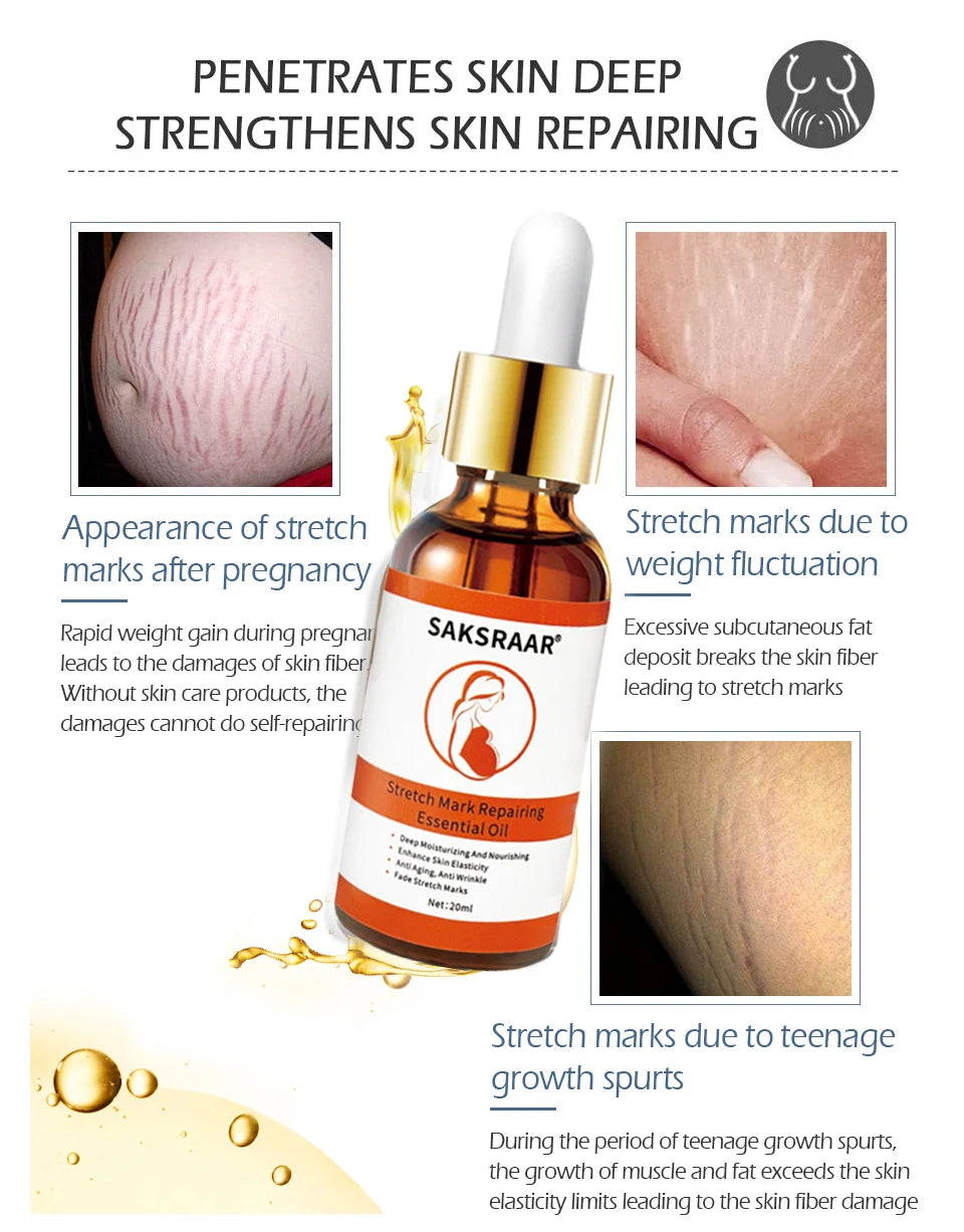 Silken Radiance: Stretch Marks Remover Cream and Essential Oil Duo for Maternal Skincare 